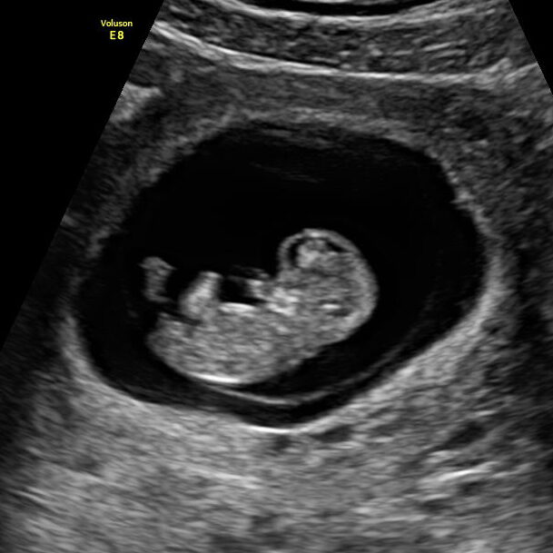 Example early 2D baby ultrasound image